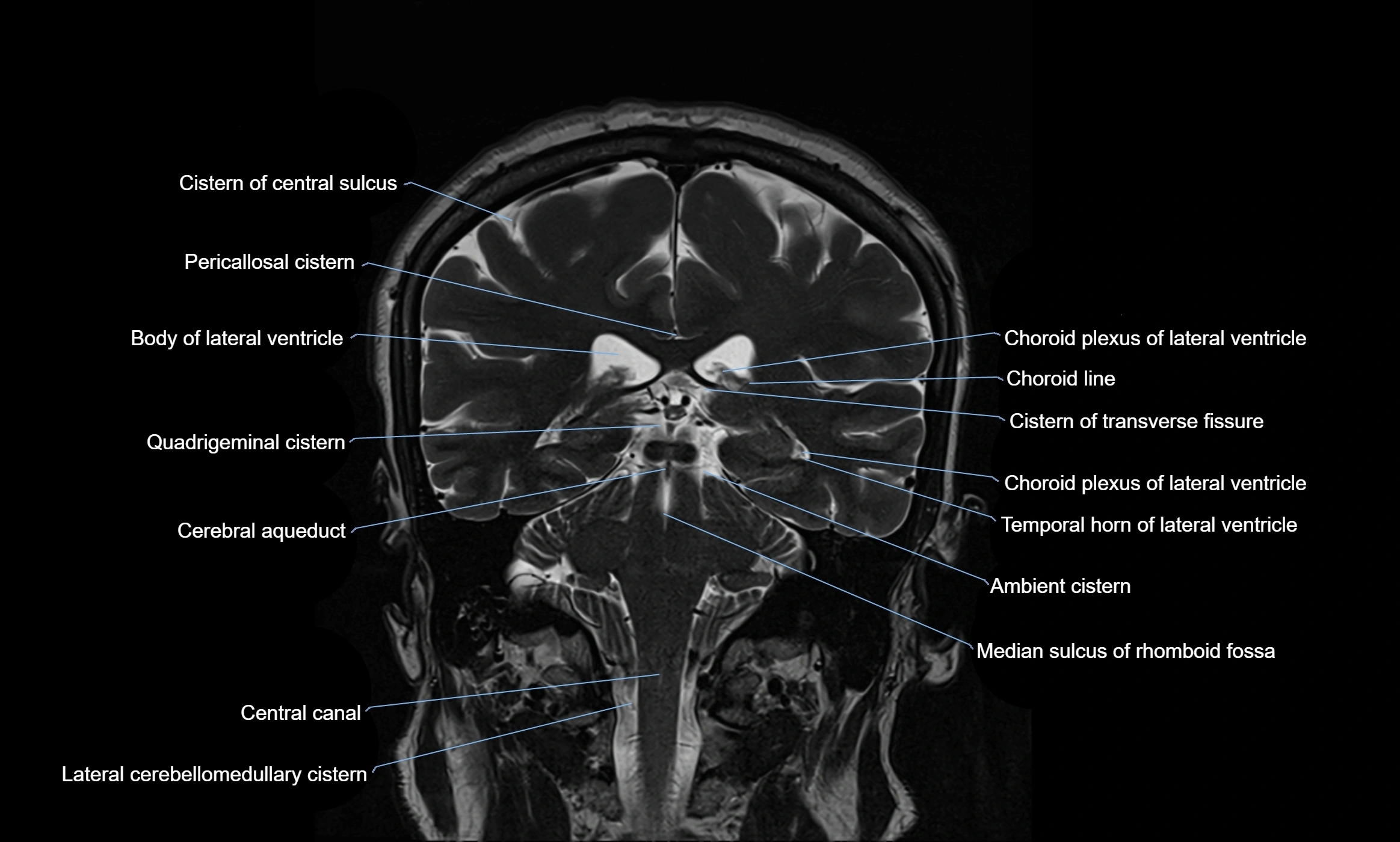 Brain cisterns  and ventricles coronal anatomy 3T MRI image-img-00001-00038.webp